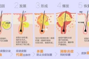 粉刺痤疮是怎么生成的（粉刺痤疮是怎么生成的）