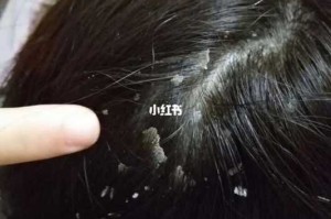 头皮屑多大块是什么原因（头皮屑多大块是什么原因）