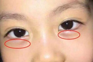 孩子的眼袋很大有点肿，是怎么回事呢,眼袋很大是怎么回事啊