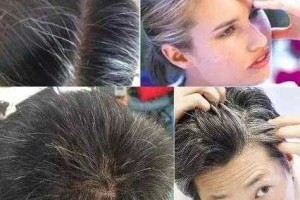 为什么有少白头（为什么有少白头的现象?）