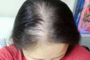 头顶上脱发怎么办（17岁女生秃顶怎么办）