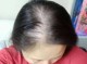 头顶上脱发怎么办（17岁女生秃顶怎么办）