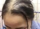 掉头发严重是怎么回事,脱发厉害是什么原因引起的女性