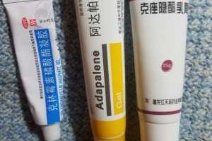 白头怎么去（去白头粉刺的药膏）