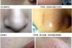 脸上有毛孔粗大如何改善,脸上毛孔粗大皮肤暗沉怎么办