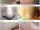脸上有毛孔粗大如何改善,脸上毛孔粗大皮肤暗沉怎么办