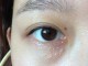 眼角的脂肪粒怎么去除（眼角脂肪粒的正确消除方法）