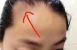 额头两边秃怎么办（头发额头两边秃怎么办）