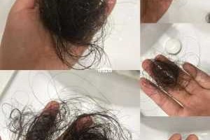 掉头发严重怎么办（掉发很严重怎么办?如何治疗脱发）