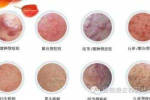 白头粉刺怎么办（女性阴部长白头粉刺怎么办）