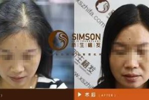 头发怎么种植,怎么样种头发好看
