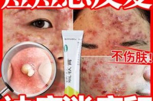 脸上肉痘怎么快速消除,脸上长暗疮怎么快速去除用什么药膏