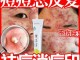 脸上肉痘怎么快速消除,脸上长暗疮怎么快速去除用什么药膏