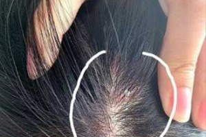 怎么治疗头皮屑（怎么治疗头皮屑和头痒）