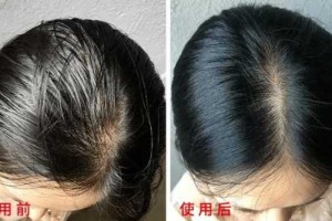 头发油掉发是什么原因（头皮发红，头发脱落）