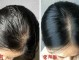 头发油掉发是什么原因（头皮发红，头发脱落）