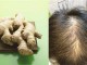 怎么去头屑最有效（生姜去头皮屑最有效方法）