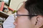 凸额头怎么办（凸额头能整平吗）