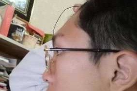 凸额头怎么办（凸额头能整平吗）