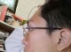 凸额头怎么办（凸额头能整平吗）