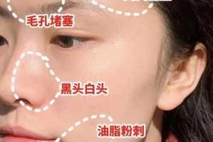 去除粉刺闭口的方法,怎么祛闭口粉刺小妙招视频