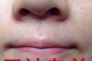 鼻子好多黑头怎么办（鼻子黑头怎么去除简单方法）
