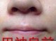 鼻子好多黑头怎么办（鼻子黑头怎么去除简单方法）