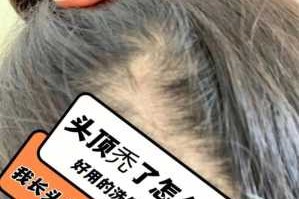 掉发很严重怎么办?如何治疗脱发,脱发怎么办呀.都成秃头了