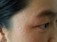 脸上都是粉刺怎么办（脸上长了很多闭合性粉刺是怎么回事？应该怎么治疗）