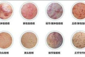 长痘属于什么（长痘属于什么皮肤病）