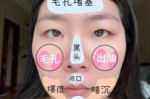 如何清理脸上的黑头,脸上黑头怎么去除最有效方法