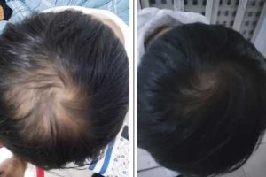 为什么前额的头发稀少（为什么前额的头发稀少 并且越来越少了）