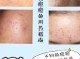 长青春痘怎么快速消除（长青春痘怎么快速消除不用药）