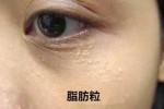 脸上很多油脂粒怎么办（满脸的油脂粒咋办）