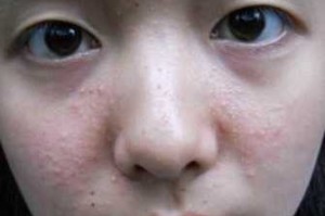 闭口粉刺是什么,闭口粉刺是什么样的图片