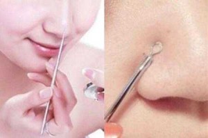 黑头怎么去掉（黑头怎么去掉最简单的方法）