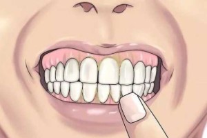牙黄用什么办法变白（牙黄怎么刷牙）