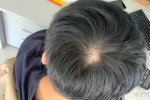 旋在右边，头发往哪边偏好看,偏额会越来越严重吗