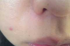 鼻子上起痘痘怎么了（鼻子上起痘痘怎么了回事）