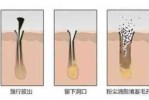 怎么样可以去掉黑头,黑头怎么能去掉不再长