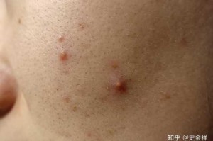 脸上全是毛孔怎么办（脸上全是毛孔怎么办）