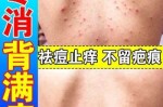 背部长痘痘怎么消除（后背长痘痘怎么消除用什么药）