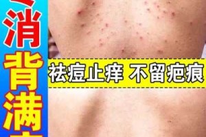 背部长痘痘怎么消除（后背长痘痘怎么消除用什么药）