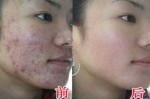 怎么去痘印最有效（怎么去痘印最有效的方法）