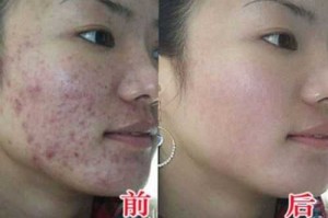 怎么去痘印最有效（怎么去痘印最有效的方法）