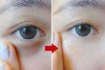 怎么有效的去除眼袋（怎么有效的去除眼袋和皱纹）