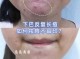 40岁的女人下巴反复长痘什么原因,妇女下巴长痘什么原因引起的