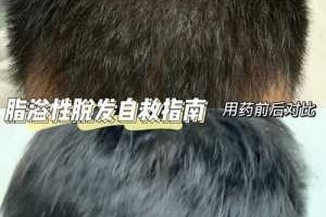 油脂性脱发怎么治疗（油脂性脱发怎么治疗最好）