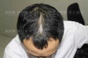 雄性激素高脱发怎么治疗,雄性激素脱发怎么治疗最好