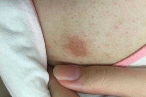 头痒怎么回事（乳头痒怎么回事）